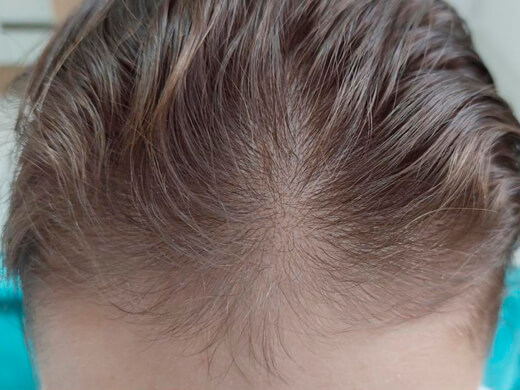 Antes do tratamento capilar - Caso 1