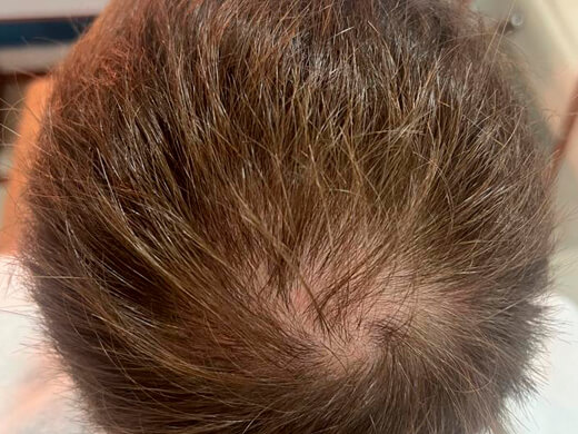 Antes do tratamento capilar - Caso 2