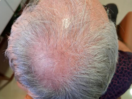 Antes do tratamento capilar - Caso 3