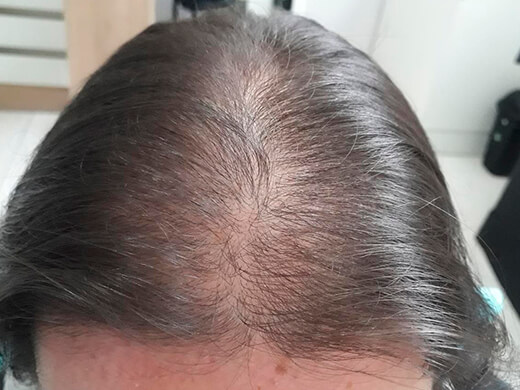 Antes do tratamento capilar - Caso 4