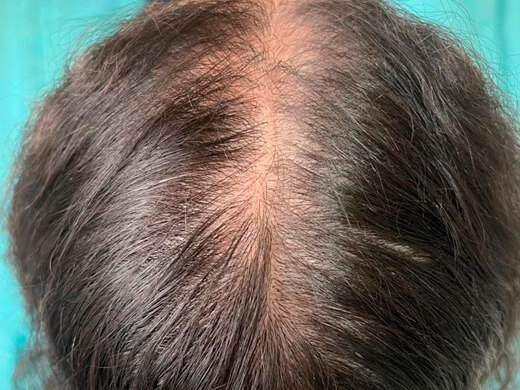 Antes do tratamento capilar - Caso 5