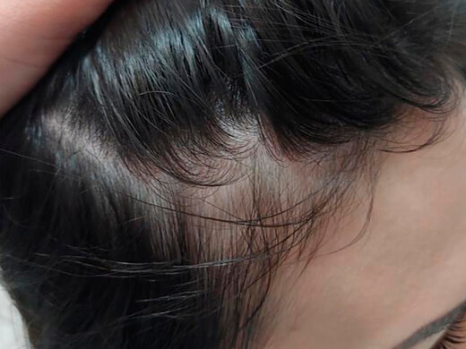 Antes do tratamento capilar - Caso 6