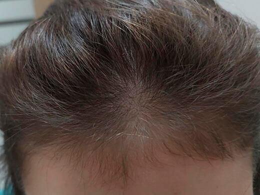 Depois do tratamento capilar - Caso 1