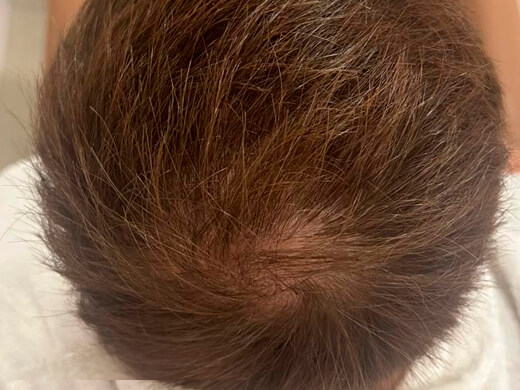 Depois do tratamento capilar - Caso 2