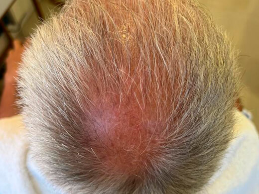 Depois do tratamento capilar - Caso 3