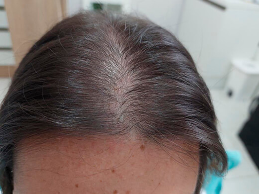 Depois do tratamento capilar - Caso 4