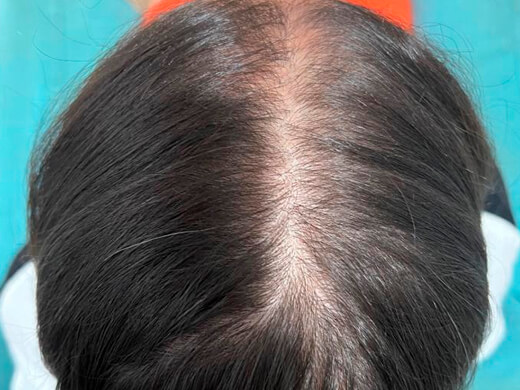 Depois do tratamento capilar - Caso 5