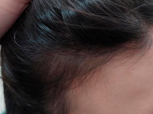 Depois do tratamento capilar - Caso 6